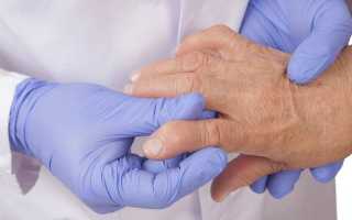 Чем опасен серопозитивный ревматоидный артрит?