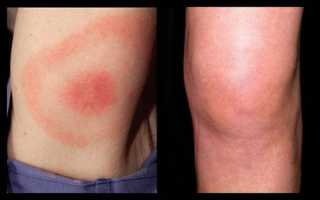 Заболевания коленного сустава: частые и редкие патологии, их симптомы и лечение