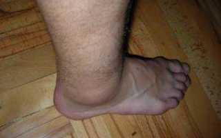 Причины и лечения отека ног в щиколотках у женщин