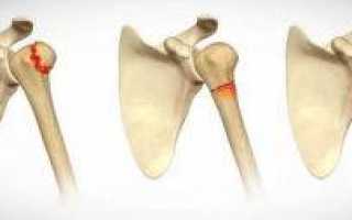 Способы как лечить перелом плечевой кости и трудности которые могут возникнуть