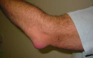 Бурсит локтевого сустава: симптомы и лечение шишки на локте