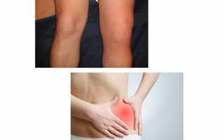 6 разновидностей синовита коленного сустава