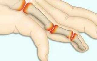 Как вылечить полиартрит пальцев рук