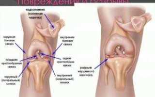 Лечение повреждения внутреннего мениска коленного сустава