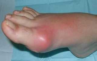 Причины и лечение отложения солей в суставах ног
