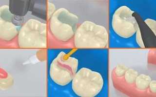 Что такое зубная культевая вкладка в стоматологии, обзор цен