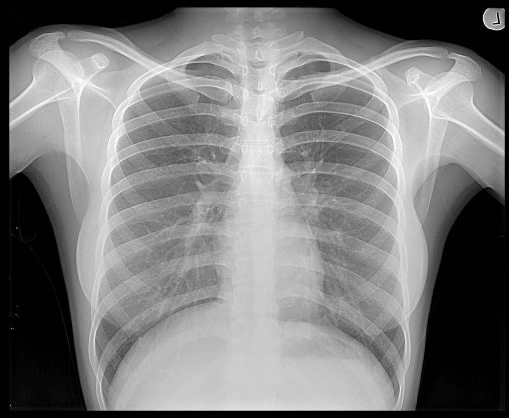 Снимок. Рентгенограмма ОГК норма. Обзорная рентгенография грудной клетки. Рентген костей грудной клетки. Рентген грудной клетки туберкулез.