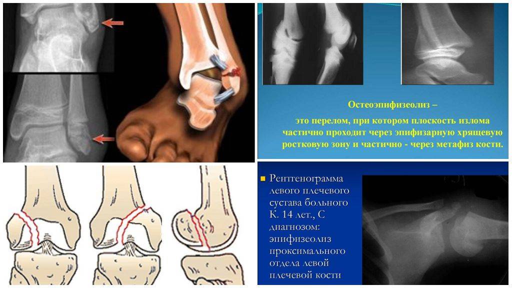 Перелом костей у детей. Перелом голеностопа эпифизеолиз. Эпифизеолиз большеберцовой кости рентген. Перелом эпифизеолиз у детей.