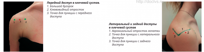Укол в дельтовидную мышцу внутримышечно. Место укола в плечо. Внутримышечная инъекция в плечо техника. Инъекция подкожно в плечо алгоритм. Внутримышечная инъекция в плечо техника.